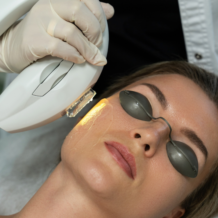 IPL Behandlung zur Entfernung von Pigmentflecken – effektive Hautverjüngung und ebenmäßiger Teint in Berlin Prenzlauer Berg