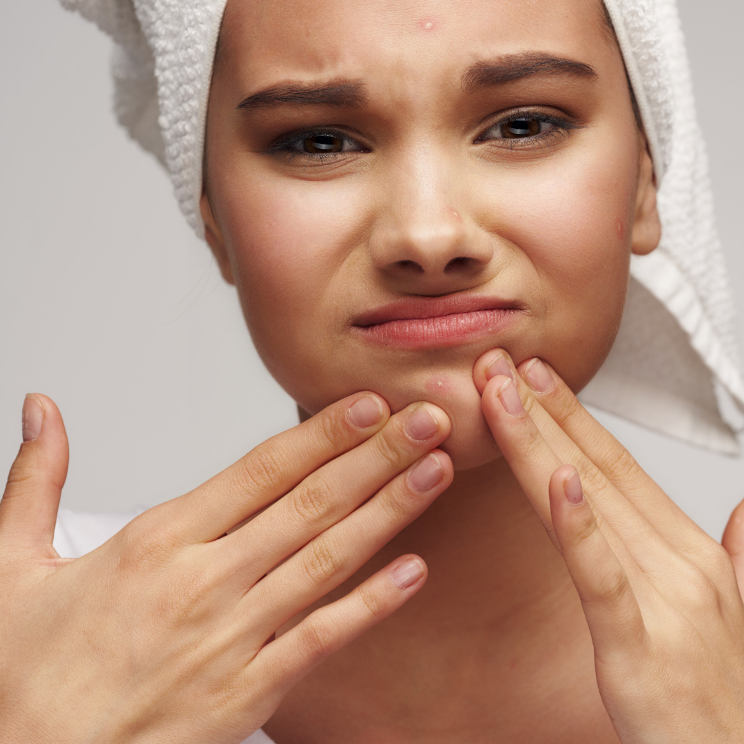 Zu Akne neigende Haut - Unsere Tipps und Tricks