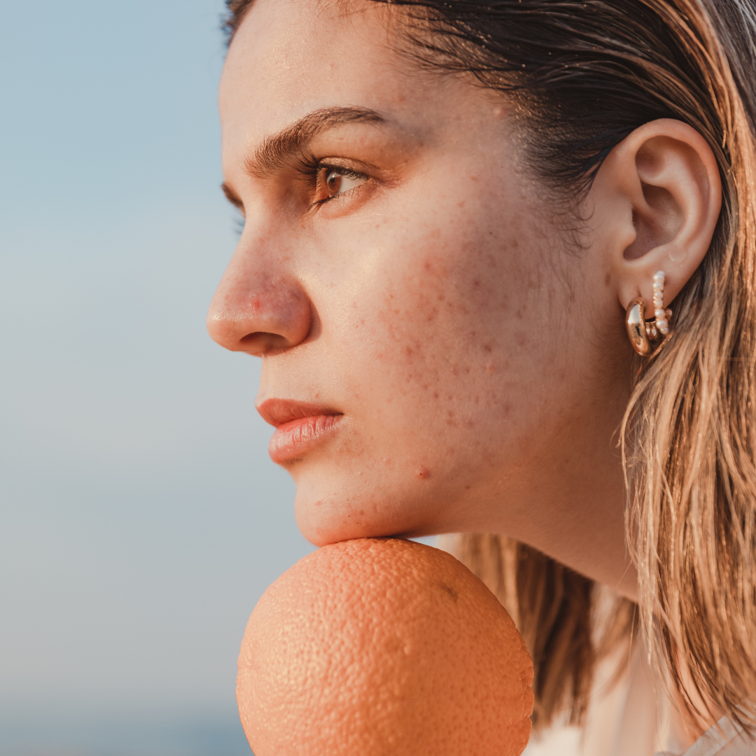 Die richtige Ernährung bei Akne