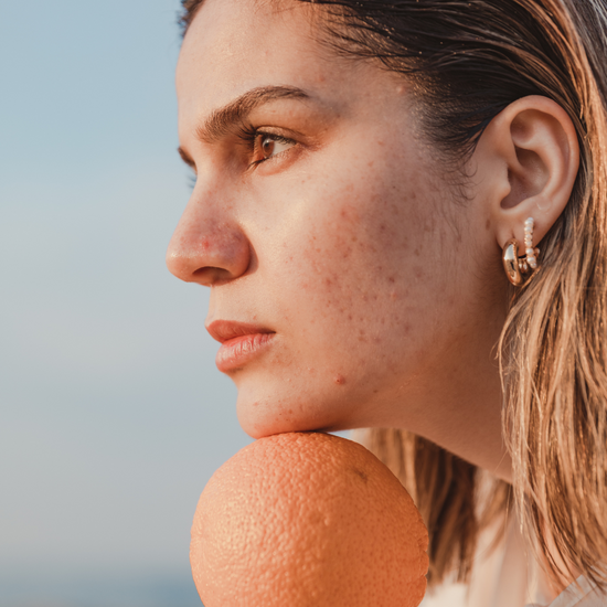 Die richtige Ernährung bei Akne