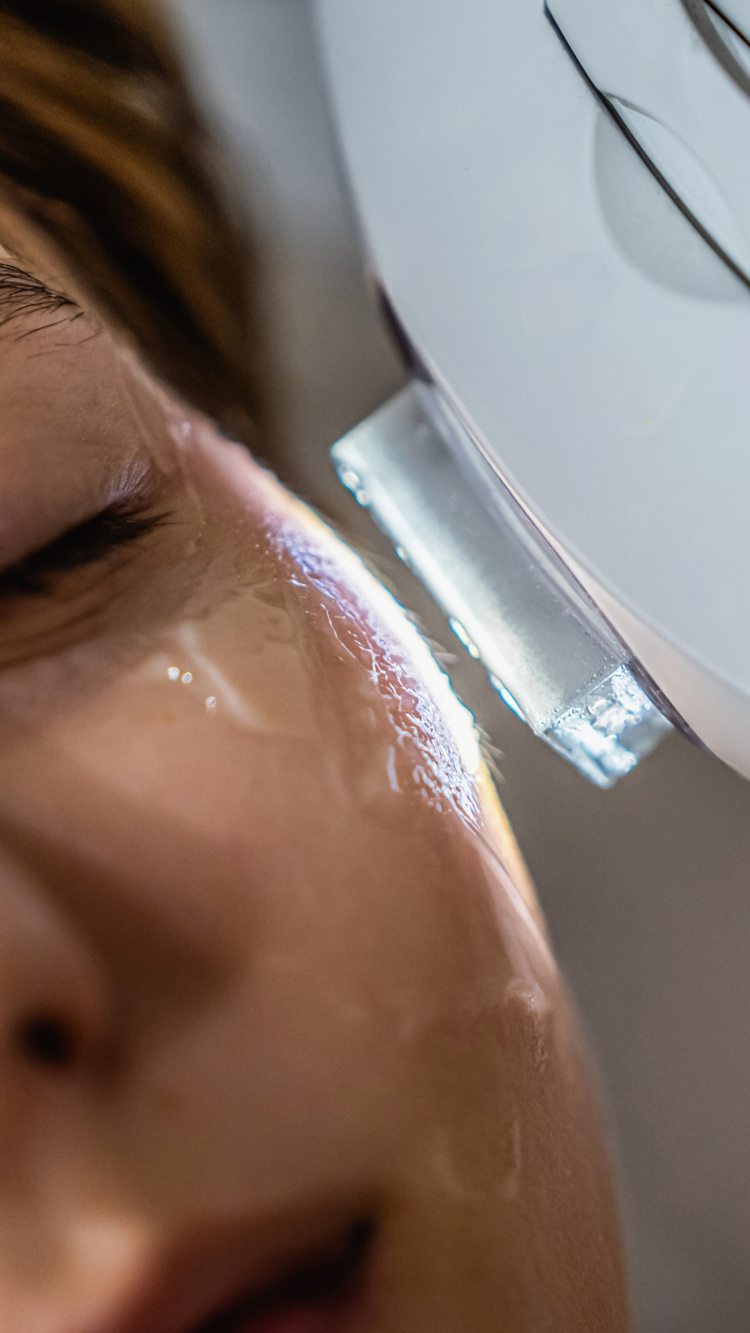 IPL Behandlung zur Reduzierung von Hautrötungen und Couperose – effektive und sanfte Hautpflege in Berlin Prenzlauer Berg